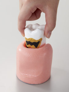 4倍大歯周病説明用模型[PE-PER014]の写真