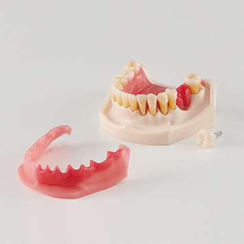 歯周病・インプラント周囲炎説明用模型[PE-PER015]の写真