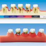 歯周病進行ステップ説明用模型[PE-PER010]の写真