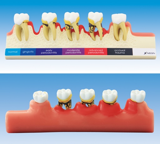 歯周病進行ステップ説明用模型[PE-PER010]の写真