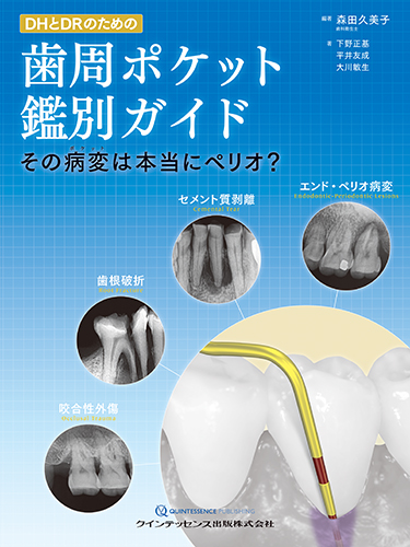 DHとDRのための歯周ポケット鑑別ガイドの写真