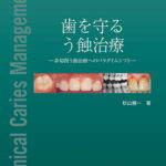 歯を守る　う蝕治療の写真