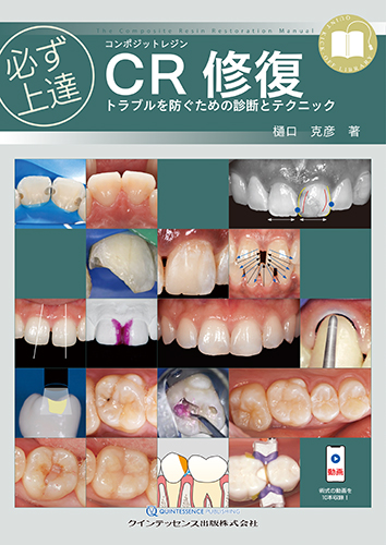 必ず上達　CR（コンポジットレジン）修復の写真