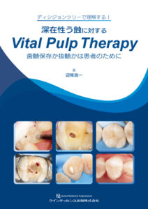 深在性う蝕に対するVital Pulp Therapyの写真