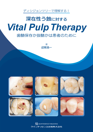 深在性う蝕に対するVital Pulp Therapyの写真